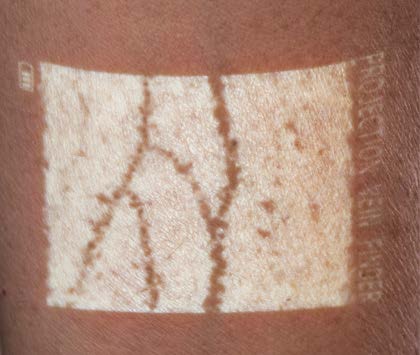 NextVein Vein Visualization System