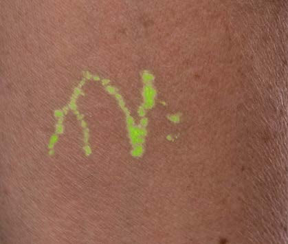 NextVein Vein Visualization System
